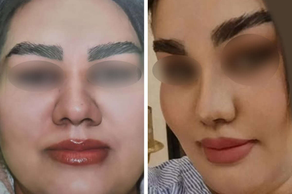 عکس قبل و بعد عمل بینی گوشتی