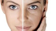  لایه برداری از پوست با طب سنتی