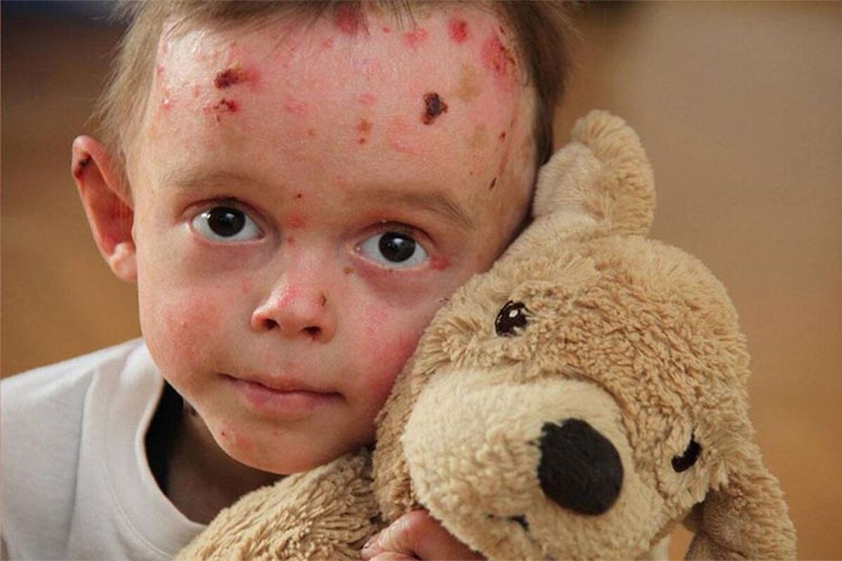 چگونه می‌توانیم به بیماران ای بی کمک کنیم؟
