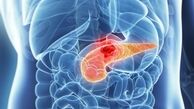 علائم ریفلاکس معده را جدی بگیرید/سه علامت خطرناک بیماری