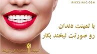 انواع لمینت دندان و قیمت (قیمت لمینت دندان 1400)