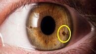 لک های درون چشم نشان از چه مشکلی است؟