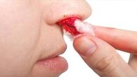 20 علت مهم خون دماغ شدن