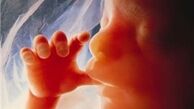 ژن موثر در ایجاد عقب‌ماندگی‌های ذهنی