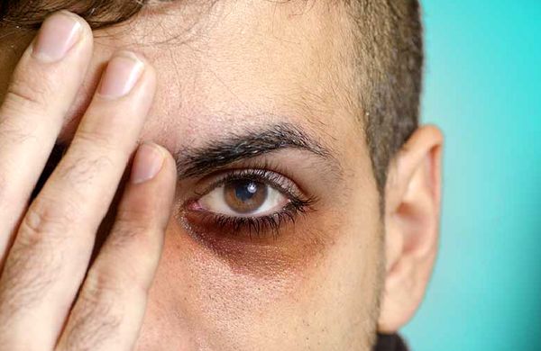 دلایل حلقه‌های تیره پای چشم