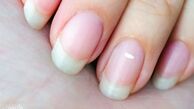 لکه سفید روی ناخن کمبود چه ویتامینی است ؟ درمان فوری سفیدی ناخن