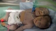 تولد نوزاد دو سر در غزه +تصاویر