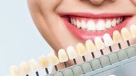 فرق کامپوزیت و لمینیت دندان چیست ؟ کدام بهتر و با دوام تر است؟