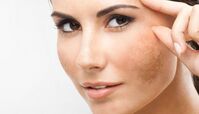 راهکار حذف لکه‌های قهوه‌ای ناشی از آفتاب روی پوست