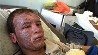 هزینه هر درصد سوختگی بدن چقدر است؟ 