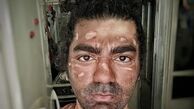 صورت بازیگر جوان سوخت + عکس