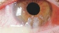 ترشحات چشم درباره سلامتی‌تان چه می‌گویند؟