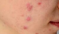 تاثیر مخرب استرس مزمن بر سلامت پوست