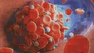 ابزار جدیدی که لخته‌های خون را شناسایی می‌کند