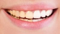 علت تغییر رنگ دندان ها چیست؟