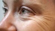 با چین و چروک دور چشم تان خداحافظی کنید