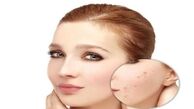از بین بردن جای جوش در سه سوت+راه مقابله با جوش زدن صورت