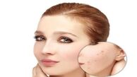 از بین بردن جای جوش در سه سوت+راه مقابله با جوش زدن صورت