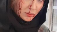 سولماز حصاری زخمی شد + عکس