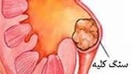 ایران روی کمربند سنگ کلیه قرار دارد
