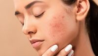 از بین بردن جای جوش با روش های خانگی ساده | این معجزه رو امتحان کن !