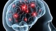 علائم هشداردهنده سکته مغزی