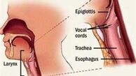 تأثیر فقر آهن در بروز سرطان مری و حنجره