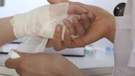 چگونه تاول ناشی از سوختگی را در کمترین زمان درمان کنیم؟