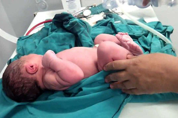 علل نگهداری خون بند ناف نوزادتان 