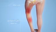 درد سیاتیک چیست؟+راه های درمان سیاتیک