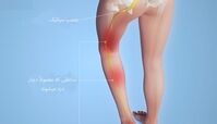 درد سیاتیک چیست؟+راه های درمان سیاتیک
