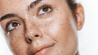 18 روش خانگی برای از بین بردن لکه های قهوه ای صورت و بدن