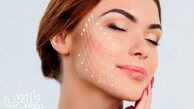لیفت صورت با نخ چگونه انجام می‌شود و چه مزایا و عوارضی دارد ؟