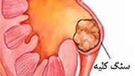 مصرف بیش از حد ویتامین C، سنگ کلیه می‌آورد