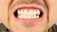علت دندان قروچه در روز و شب چیست ؟ عوارض ؛ پیشگیری ؛ درمان